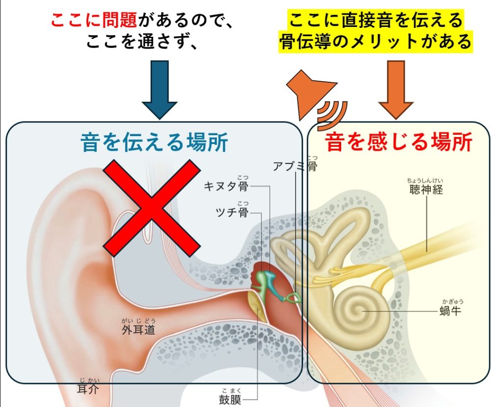 伝音難聴の場合に骨伝導補聴器が有効であることを説明する図