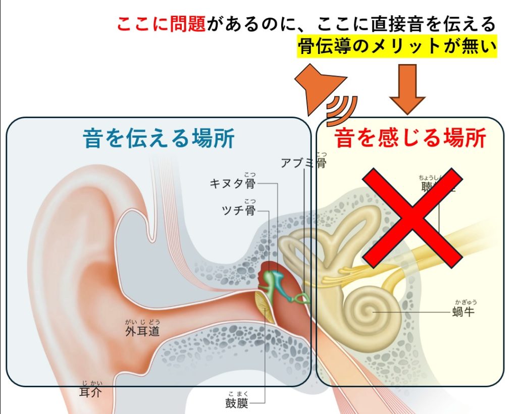 加齢性難聴や突発性難聴のような感音難聴に対して、骨導補聴器が効果がい理由の図解